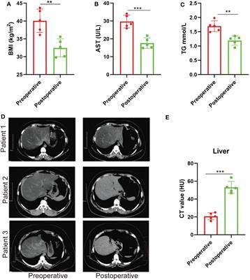 Increased plasma genistein after bariatric surgery could promote remission of NAFLD in patients with obesity